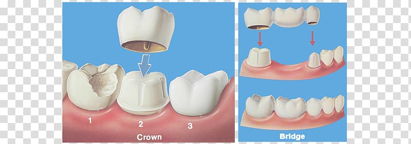 Bridge Crown Dentistry Dental restoration, bridge transparent background PNG clipart