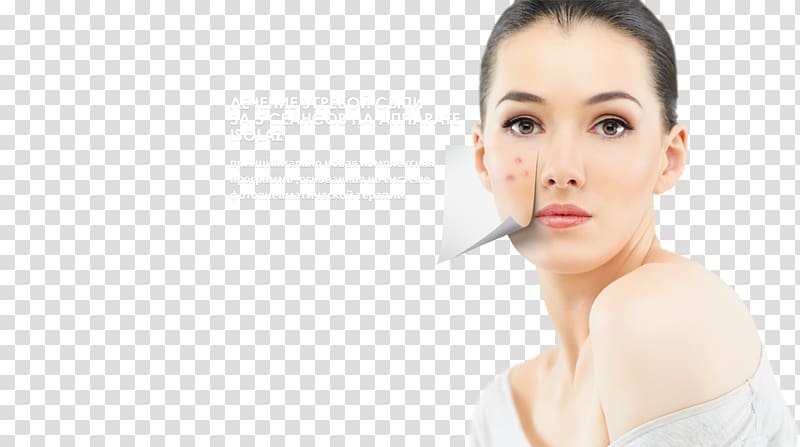 woman wearing white top, Skin care Acne Health Therapy, acne transparent background PNG clipart
