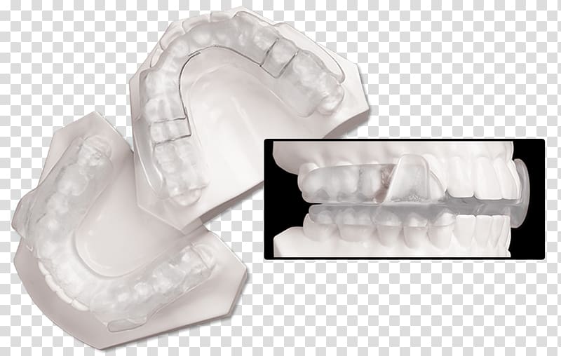 Splint Temporomandibular joint dysfunction Dentistry Jaw Orthopedic surgery, others transparent background PNG clipart