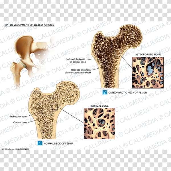 Hip Osteoporosis Rheumatology Osteoarthritis Illustration anatomique, Osteoporosis transparent background PNG clipart