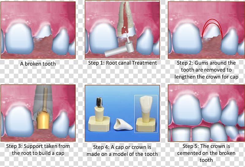 Crown Root canal Cracked tooth syndrome Human tooth, crown transparent background PNG clipart
