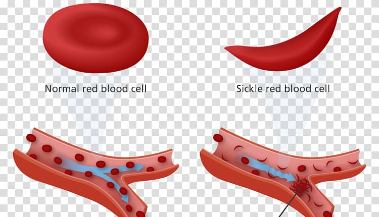 Sickle cell disease Anemia Sickle cell trait Red blood cell, world health day transparent background PNG clipart