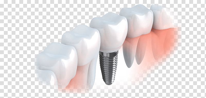 Dental implant Restorative dentistry Oral hygiene, crown transparent background PNG clipart