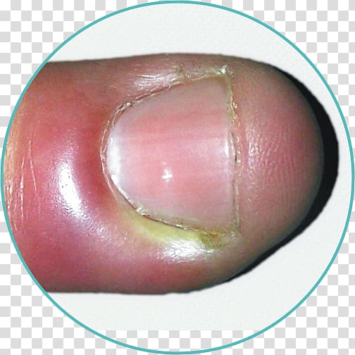 Nail Paronychia Inflammation Folliculitis Infection, Nail transparent background PNG clipart