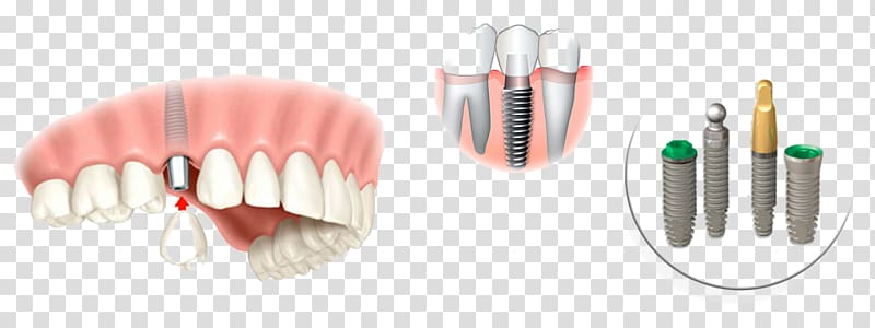 Dental implant Dentistry Tooth Implantology, crown transparent background PNG clipart