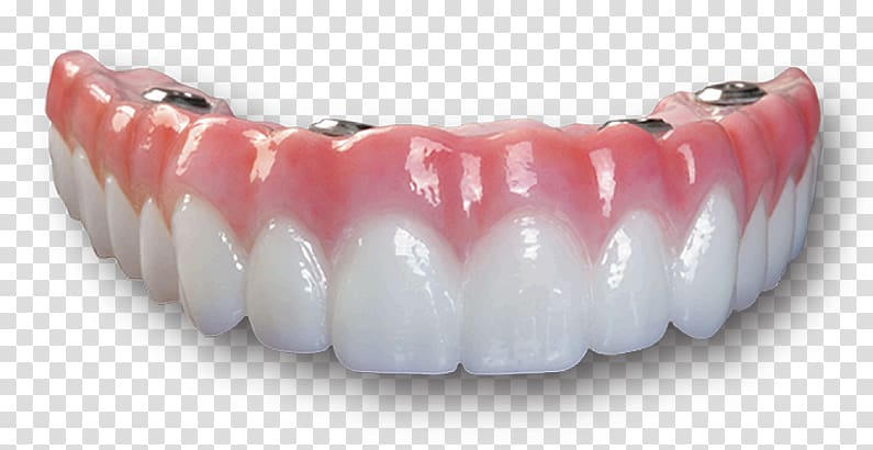 Dental implant Bridge Dentures Dentistry All-on-4, dental implants transparent background PNG clipart