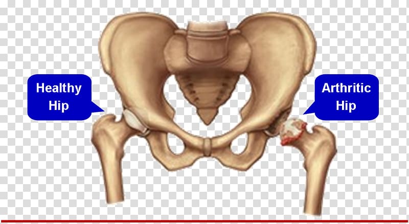 Hip replacement Joint replacement Surgery Knee replacement, meniscus transparent background PNG clipart