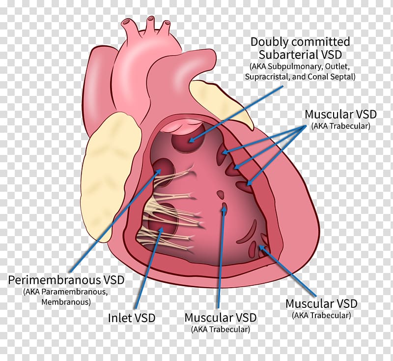 Heart Ventricular septal defect Interventricular septum Ventricle, heart transparent background PNG clipart