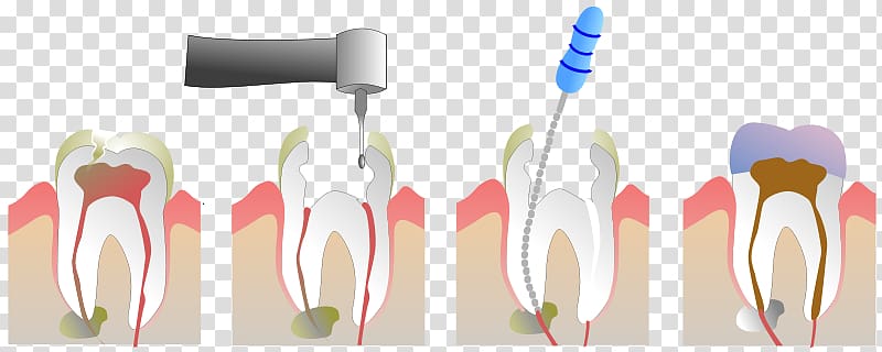 Endodontic therapy Root canal Pulp Endodontics Dentistry, others transparent background PNG clipart