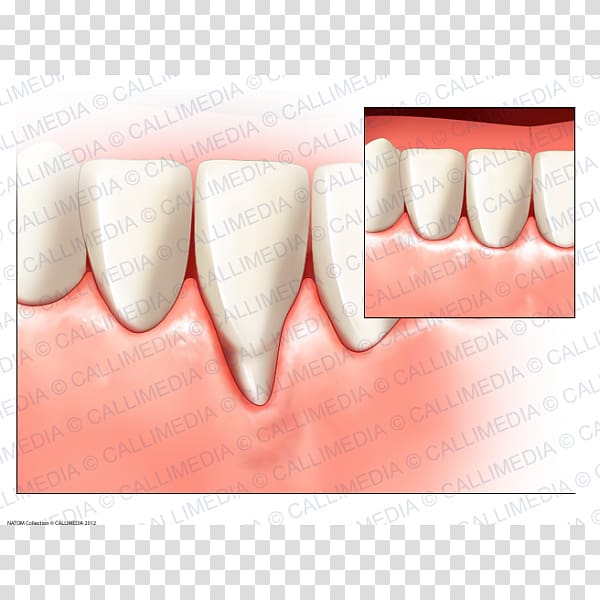 Tooth Gums Surgery Periodontal disease Gingival recession, health transparent background PNG clipart