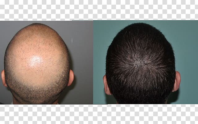 Hair transplantation Follicular unit extraction Follicular unit transplantation Hair loss Organ transplantation, Hair transplant transparent background PNG clipart