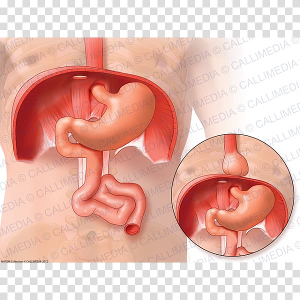 Hiatal hernia Stomach Gastroesophageal reflux disease Gastroenterology, gastric transparent background PNG clipart