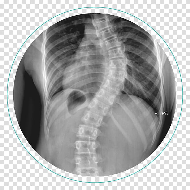Scoliosis X-ray Vertebral column Physical therapy Cobb angle, rib cage transparent background PNG clipart