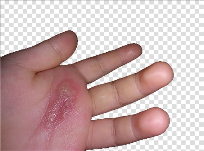 Hand Nail Thumb, Burned hands hand portrait transparent background PNG clipart
