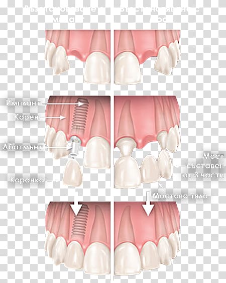 Tooth Cosmetic dentistry Dental implant Bruxism, others transparent background PNG clipart