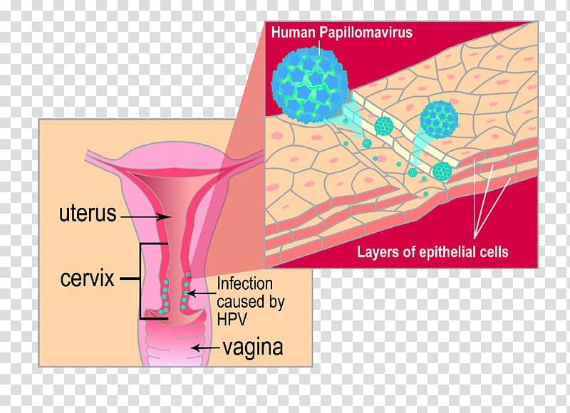 Gardasil Genital human papillomavirus infection Genital wart Cervical cancer, others transparent background PNG clipart