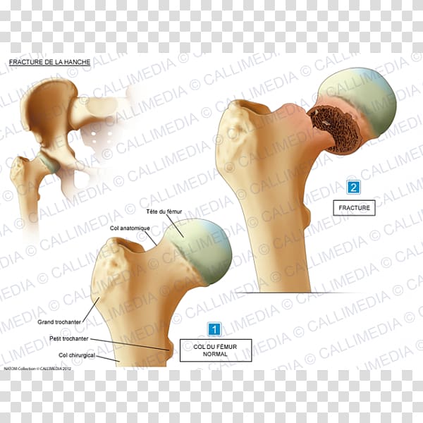 Hip fracture Shoulder Bone fracture Femur, Fractures transparent background PNG clipart