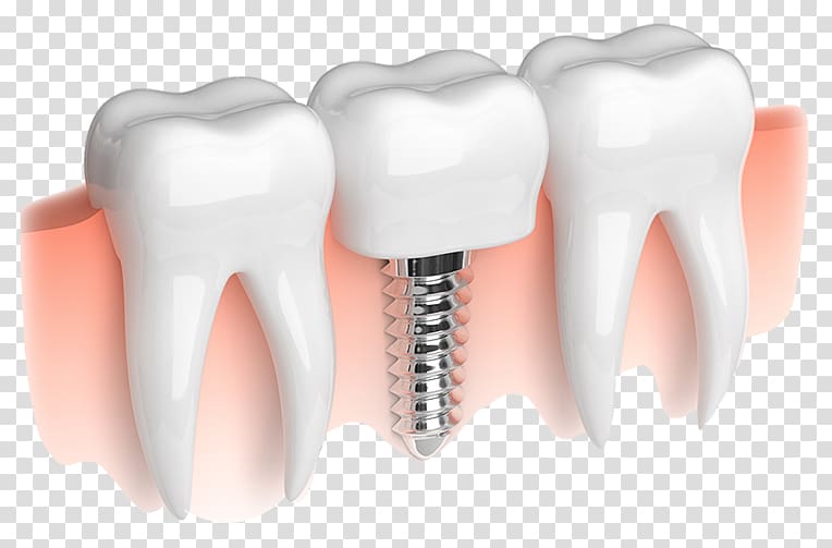 Dental implant Dentistry Smiles on State Street, Implants transparent background PNG clipart