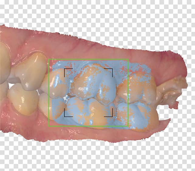 Orthodontics Computer Software scanner Occlusion, oral shaping transparent background PNG clipart