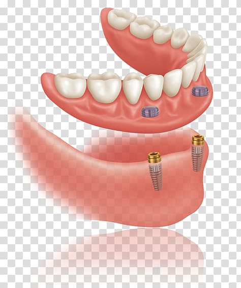 Dentures Dental implant Bridge Implant bars Dentistry, bridge transparent background PNG clipart