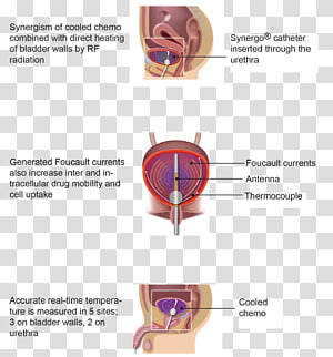 Therapy Bladder cancer Mitomycin C Patient Disease, others transparent background PNG clipart thumbnail