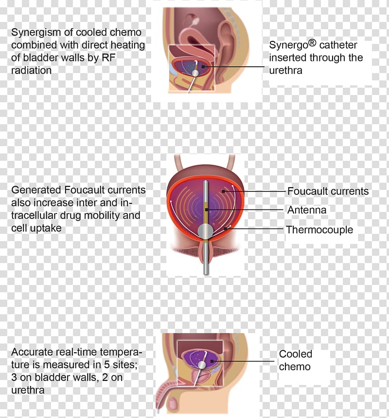 Therapy Bladder cancer Mitomycin C Patient Disease, others transparent background PNG clipart