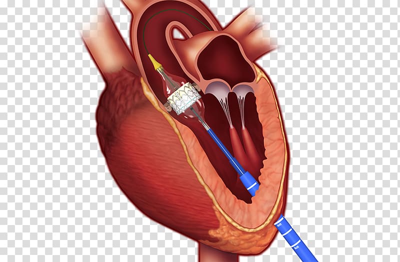 Percutaneous aortic valve replacement Valvular aortic stenosis Surgery, heart transparent background PNG clipart