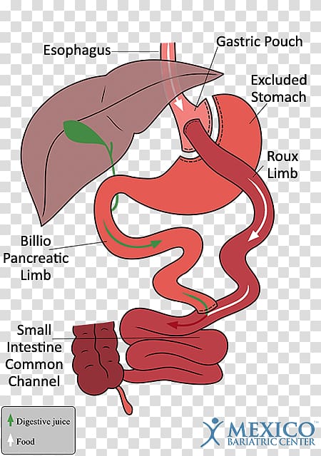 Gastric bypass surgery Bariatric surgery Sleeve gastrectomy Gastric balloon, small intestine transparent background PNG clipart