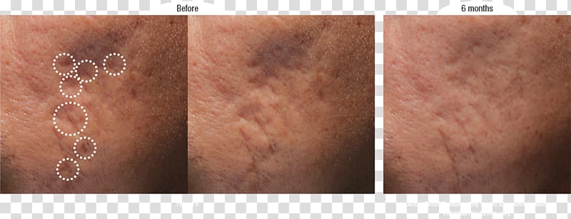 Botulinum toxin Wrinkle Clostridium botulinum Injectable filler Cosmetics, Acne Scars transparent background PNG clipart