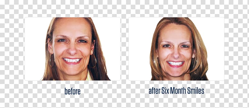 Cosmetic dentistry Dental braces Overbite, before and after transparent background PNG clipart