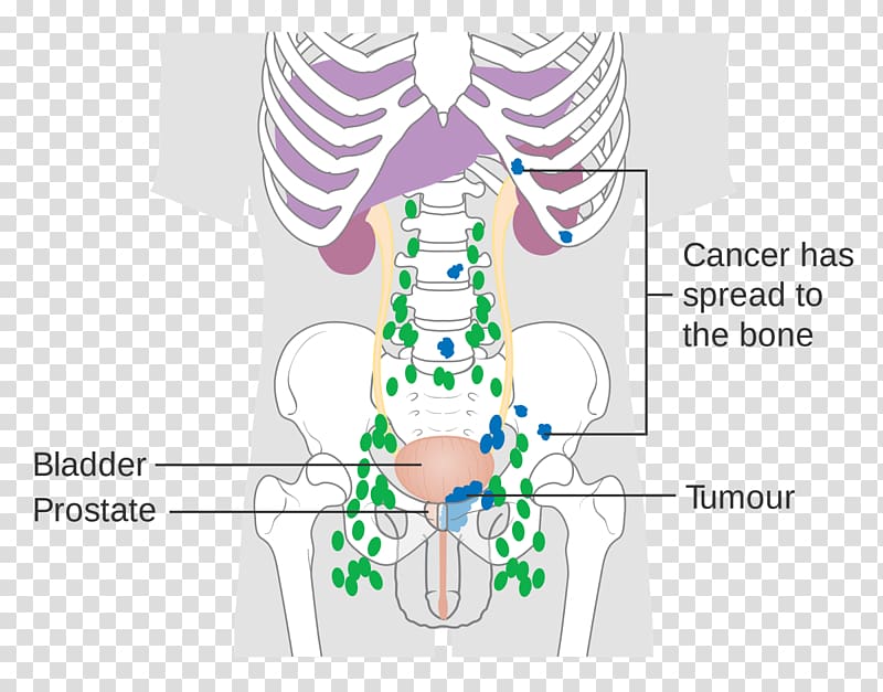 Prostate cancer Lymph node Metastasis Prostate-specific antigen, Lycopene lowers risk of prostate transparent background PNG clipart