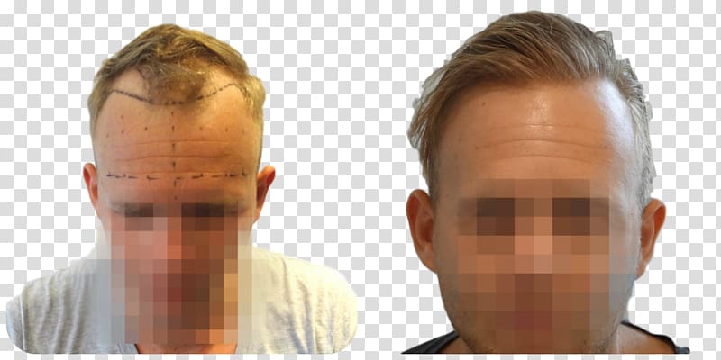 Hair transplantation Follicular unit extraction Eyebrow Hairstyle, others transparent background PNG clipart