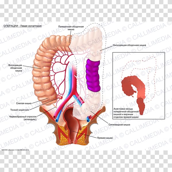 Rectum Colorectal cancer Hemikolektomie Anatomy Colectomy, sol anahtarÄ± transparent background PNG clipart
