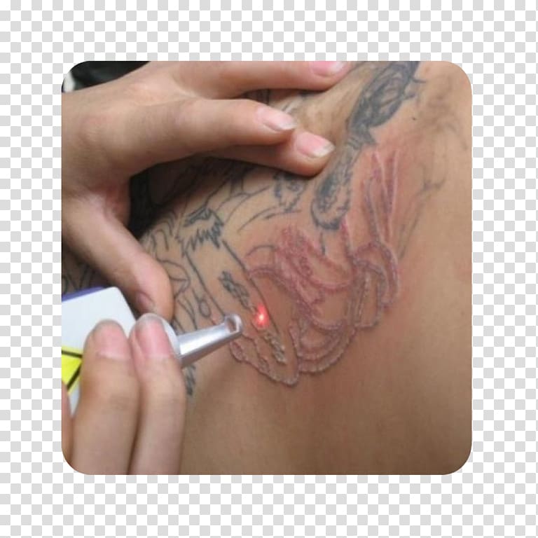 Nail Ojas Aesthetic Tattoo removal Abziehtattoo Surgery, Nail transparent background PNG clipart