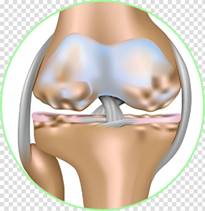 Osteoarthritis Joint effusion Knee effusion, Khop transparent background PNG clipart