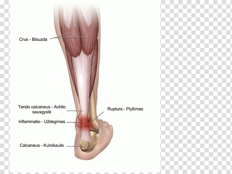 Achilles tendinitis Achilles tendon Achilles\' heel, others transparent background PNG clipart