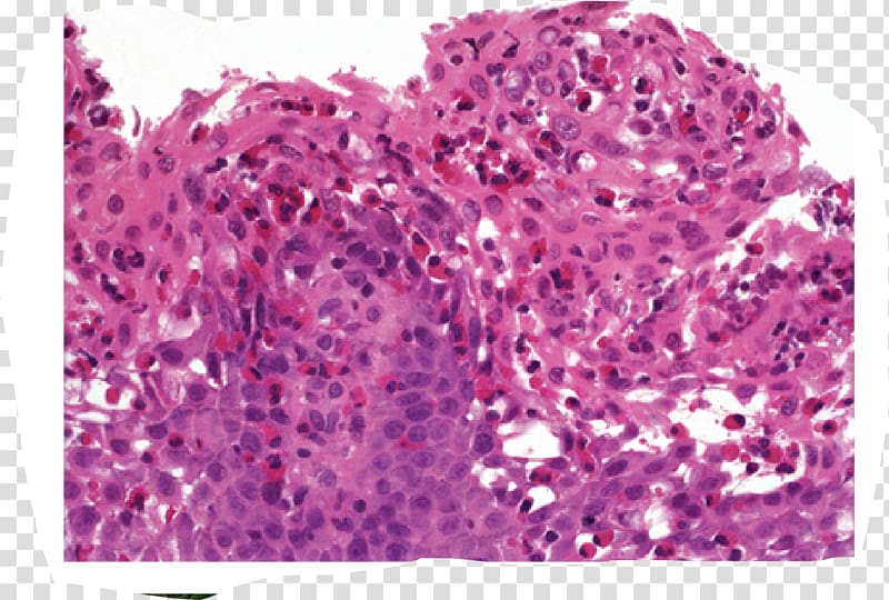 Eosinophilic esophagitis Esophagus Dysphagia, others transparent background PNG clipart