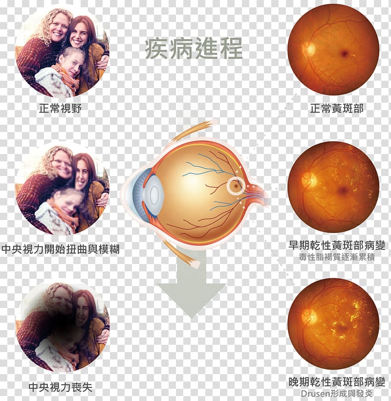 Macular degeneration Macula of retina Old age Blindness, Eye transparent background PNG clipart