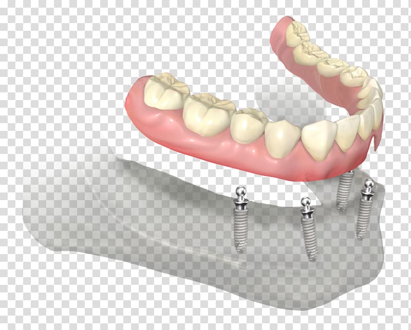 Dentures Dentistry Dental implant Abutment Prosthesis, teeth transparent background PNG clipart