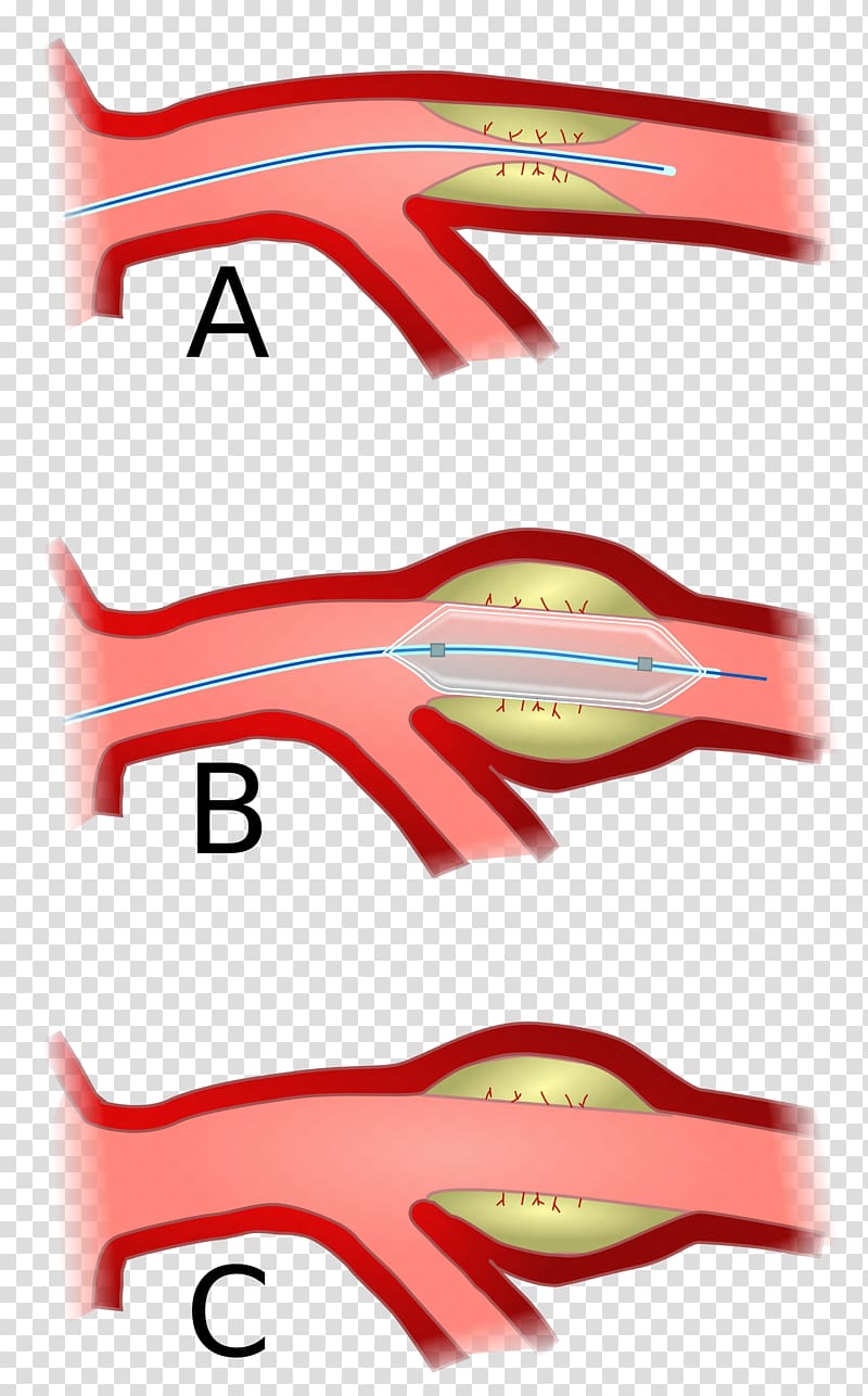 Angioplasty Percutaneous coronary intervention Coronary artery disease Angina pectoris, heart transparent background PNG clipart