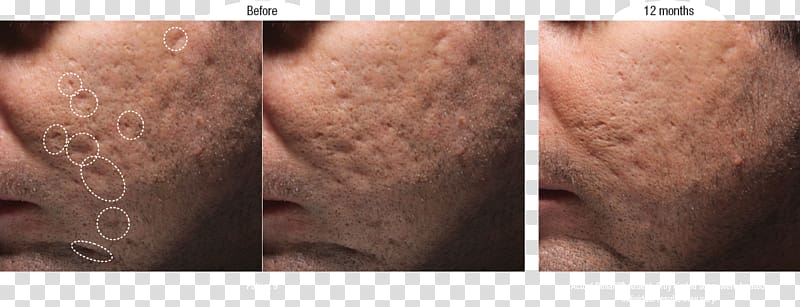 Scar Injectable filler Acne Botulinum toxin Wrinkle, Acne Scars transparent background PNG clipart