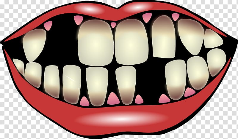 Tooth pathology Tooth decay Dentistry , Bright Teeth transparent background PNG clipart