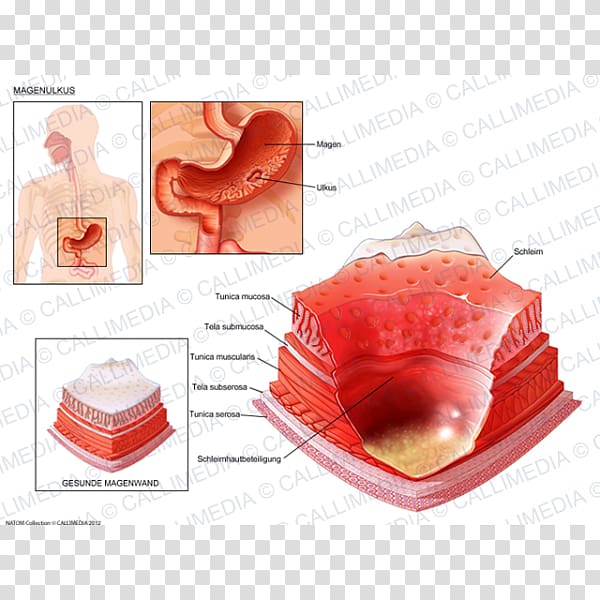 ＴＭＣ三鷹健診センター Peptic ulcer disease Skin ulcer Inflammation Gastritis, 360 Degrees transparent background PNG clipart