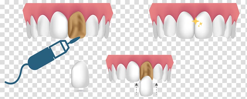 Cosmetic dentistry Veneer Dental composite Human tooth, Dental Hospital transparent background PNG clipart