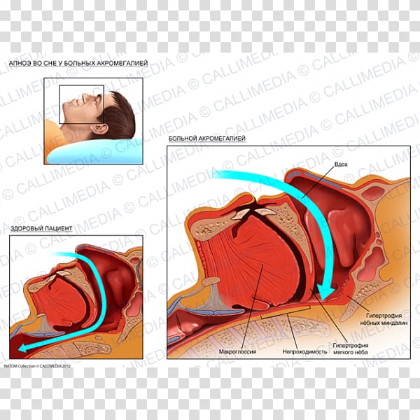 Diabetology Endocrinology Acromegaly Diabetes mellitus Endocrine system, acromegalia transparent background PNG clipart