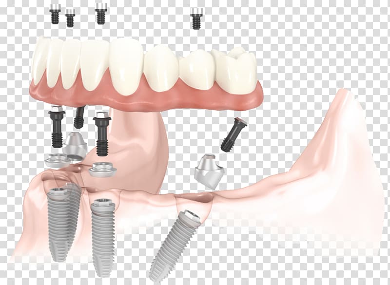 All-on-4 Dental implant Dentistry, bridge transparent background PNG clipart