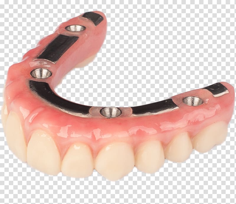 Tooth Dentures Dental implant Prosthesis, bridge transparent background PNG clipart