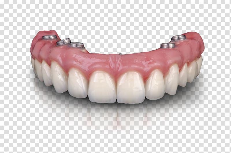Dental laboratory Bridge Tooth Redstone Arsenal Dental implant, Dental Laboratory transparent background PNG clipart