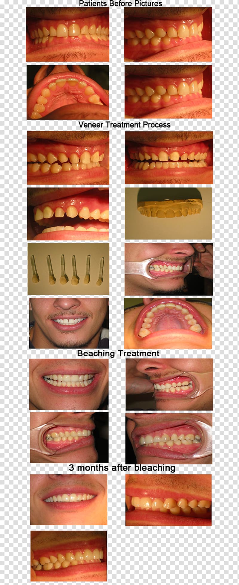 Veneer Dentistry Dental porcelain Tooth, veneers transparent background PNG clipart