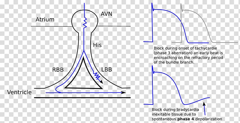 Left Bundle Branch Block Right Bundle Branch Block Bundle branches Electrical conduction system of the heart, others transparent background PNG clipart